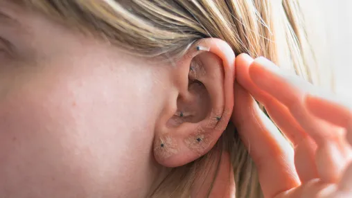Sesión de Auriculoterapia con semillas